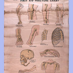 Wall Chart - First Aid Fracture Chart, circa 1930