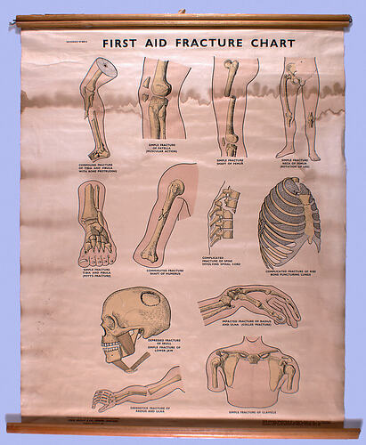 Wall Chart - First Aid Fracture Chart