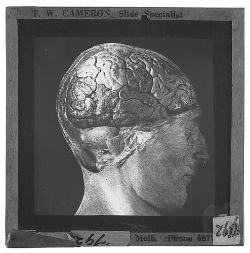 Lantern Slide - Universal Opportunity League, Head with Brain Exposed