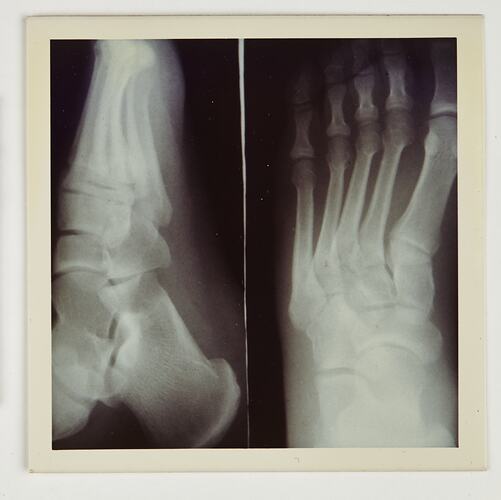 X-rays of a human foot.