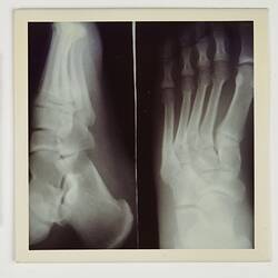 Photograph - Eastman Kodak, Feet X-rays, circa 1970s
