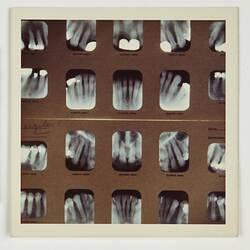 Photograph - Eastman Kodak, Dental X-Rays, circa 1970s