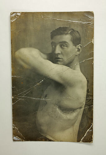 Soldier's naked upper body showing large wound.